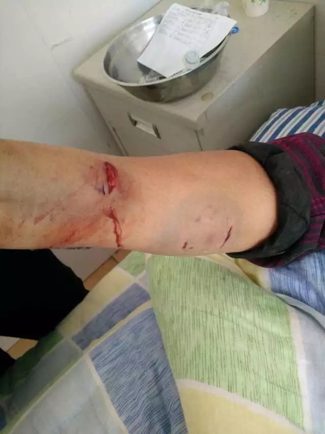  大妈外出干农活 路上被狗咬进医院