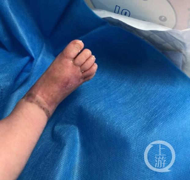 奶奶用橡皮筋给孙女捆棉袜 女婴右脚险些被截肢