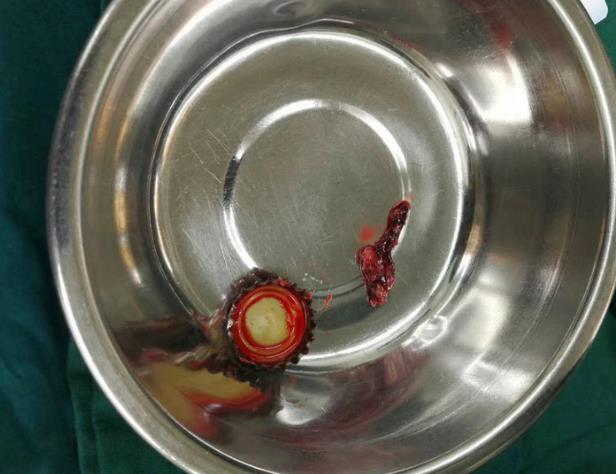 大叔想不起来误吞了什么  医生从食管里取出一个啤酒瓶盖