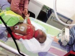 1岁男孩被烫成重伤 你愿意帮帮他吗？