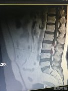 西南地区首例内镜微创切除脊髓肿瘤手术 患者一周下地