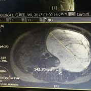 3斤半重的肿瘤在肚中 男子还以为是胃下垂