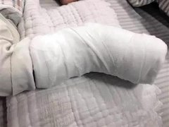 1岁小孩玩电吹风 吹着被子烧伤腿