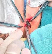 小孩摔一跤一个月烦躁不安 原是12厘米长树枝插脸上