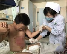 双胞胎模仿动画片情节 一名孩子胸腹烧成重伤