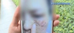 女子微信除斑反进医院 满脸水泡皮肤又红又痒