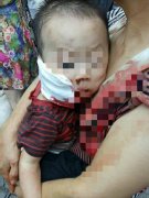 心疼！重庆一幼童脸部被飞出来的刀片划伤