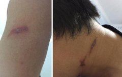 男子感觉有虫在腿上爬  一看竟是隐翅虫