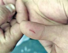 7岁小孩伸手逗猫被抓伤 夏季动物变暴躁要小心
