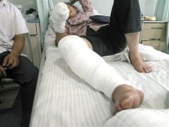在家用酒精拔火罐 老人被烧伤