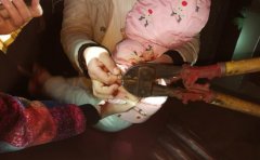 大人粗心孩子遭殃 1岁幼童手卡“削皮器”