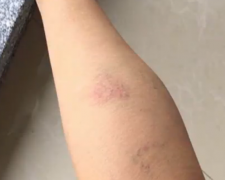 女子被大狗咬伤索赔遭拒  对方：无理取闹！