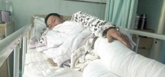 充电干电池突然爆炸 火苗扑上来烧伤他的腿
