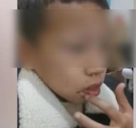 两小孩打架 家长不劝还将对方孩子打出血