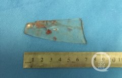 男子工地上摔了一跤 7厘米长玻璃扎破下巴刺入口中