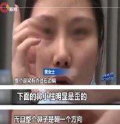 女子整形想要“高鼻梁” 结果鼻子变歪了