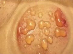 女子拔火罐被烫伤 美容院拒付治疗费用