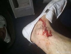 男子被狗咬伤  民警积极送医