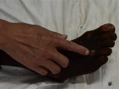 男子被毒蛇咬伤 右腿变得乌黑