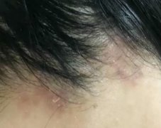 女子买了个染发剂来染白发 染了之后头皮又红又肿又痛